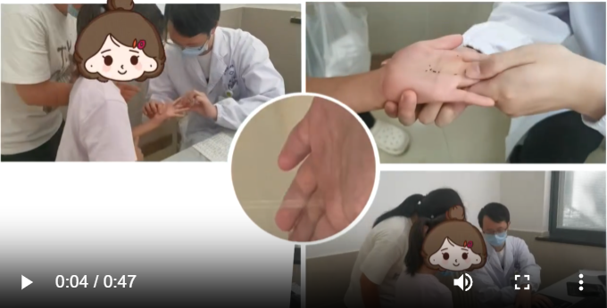 小女孩在家睡觉时未关窗户，醒来后手掌上停留了一只蝙蝠！