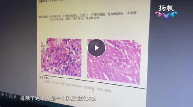 介入手术诊疗优势多 缓解痛苦恢复好【天天健康】